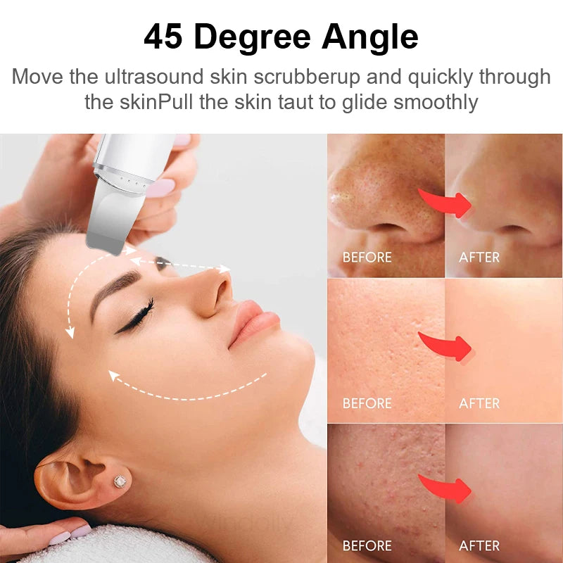 Windaily Advanced Cavitation Face Spatula Scrubber - Deep Cleanse & Rejuvenate