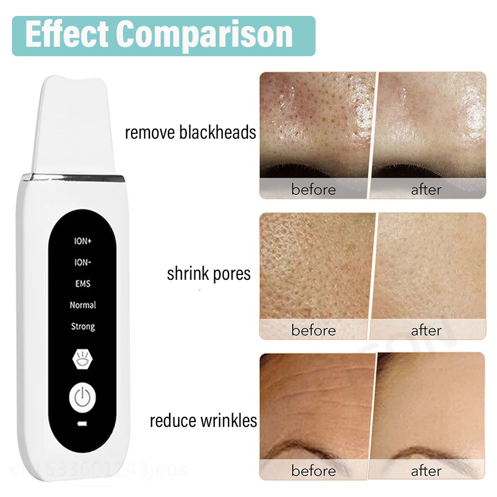 Peicon Professional Ultrasonic Skin Scrubber - Deep Cleansing & Exfoliation