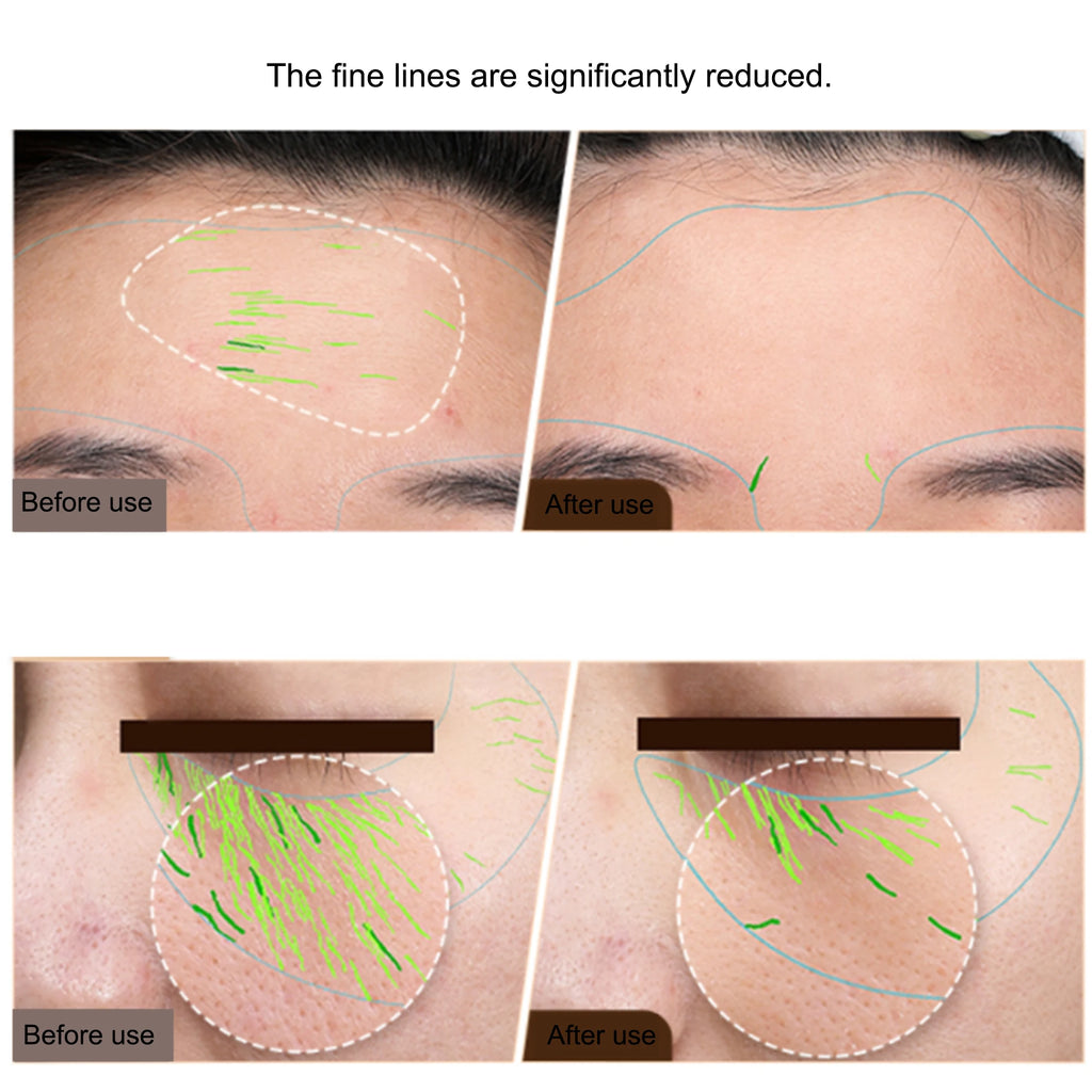 EMS RF Facial Body Machine | Skin Tightening Face Lift & Anti-Aging Device for Home & Pro Use