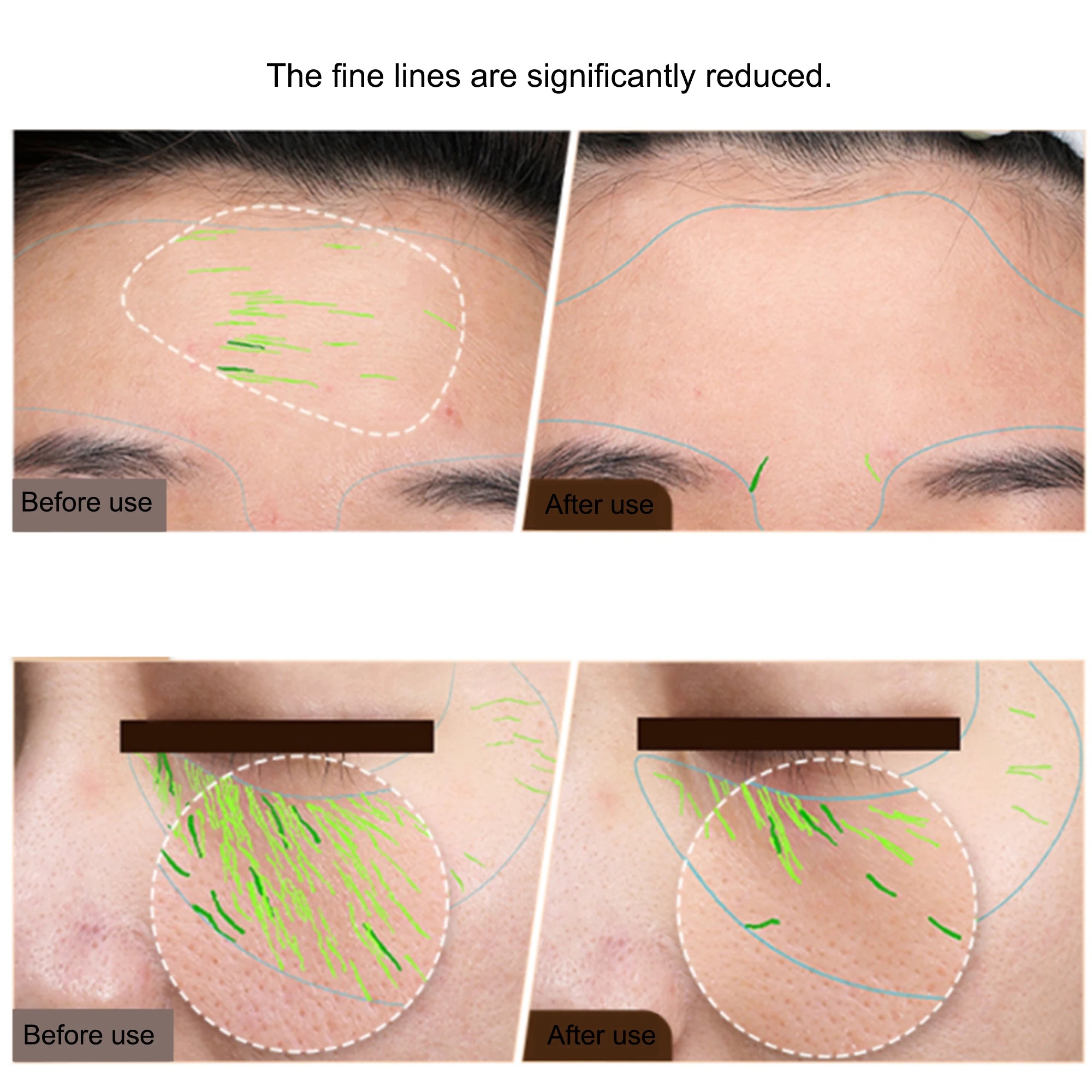 EMS RF Facial Body Machine | Skin Tightening Face Lift & Anti-Aging Device for Home & Pro Use