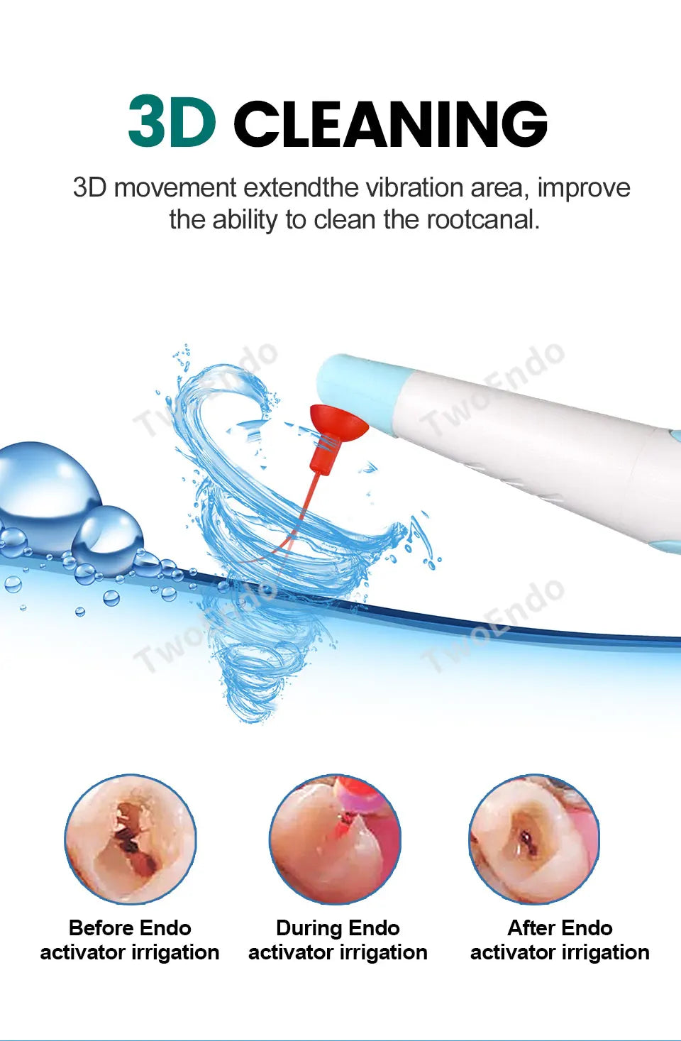 60Pcs Dental Sonic Irrigator Tips for Root Canal Cleaning & Endodontic Tools
