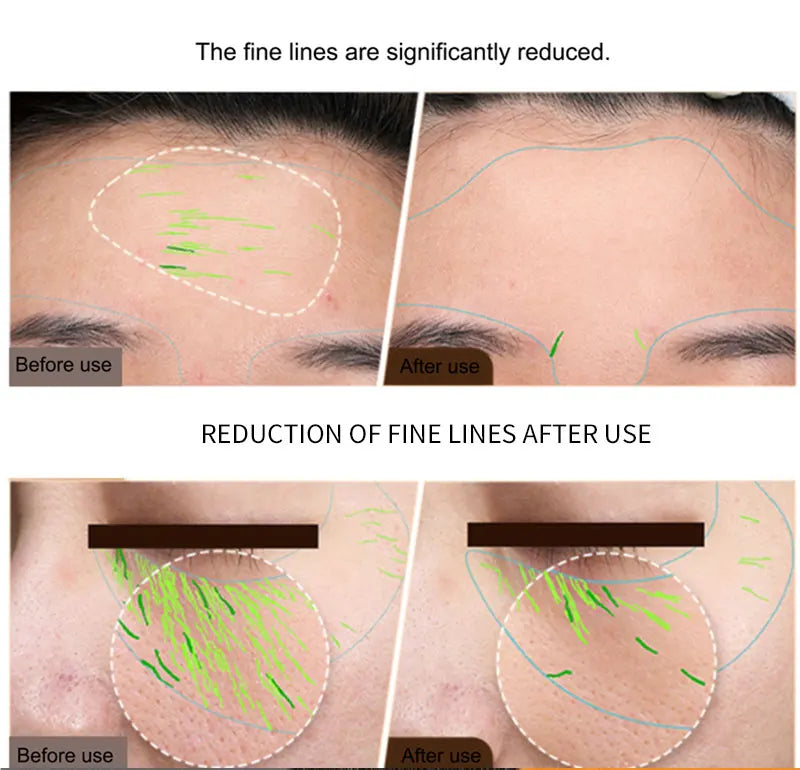 EMS RF Facial Body Machine | Skin Tightening Face Lift & Anti-Aging Device for Home & Pro Use