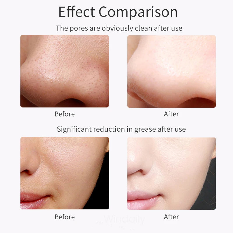 Windaily Advanced Cavitation Face Spatula Scrubber - Deep Cleanse & Rejuvenate